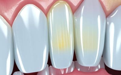 Zoom Whitening Cost: Breakdown & Factors to Consider